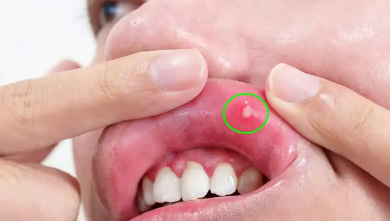 Kanser Belirtilerini Göz Ardı Eden Genç Adamın Şaşırtıcı Hikayesi
