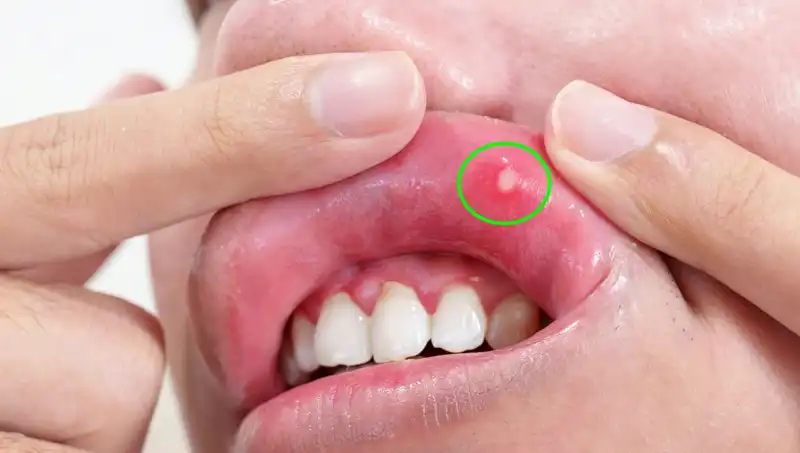 B Vitaminleri Eksikliği: Vücudu Tehdit Eden 5 Belirgin Belirti